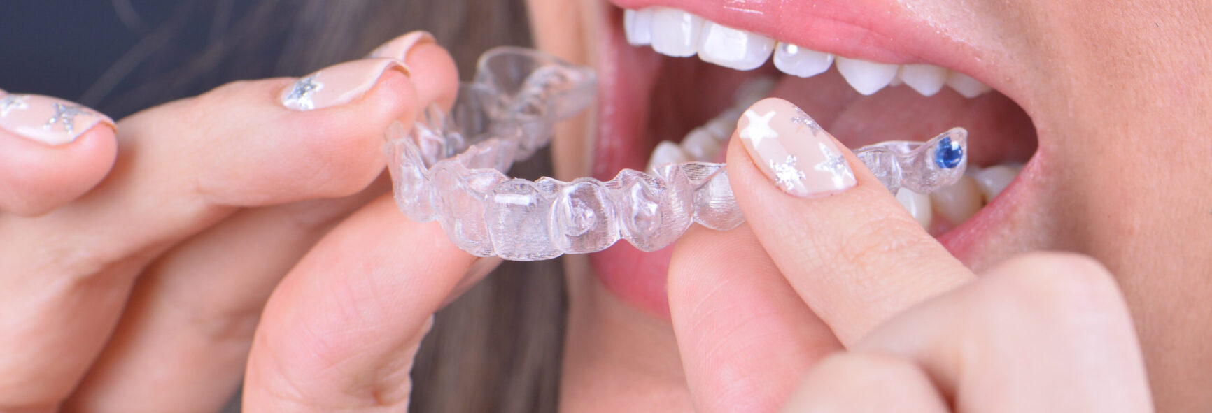 invisalign thumb 